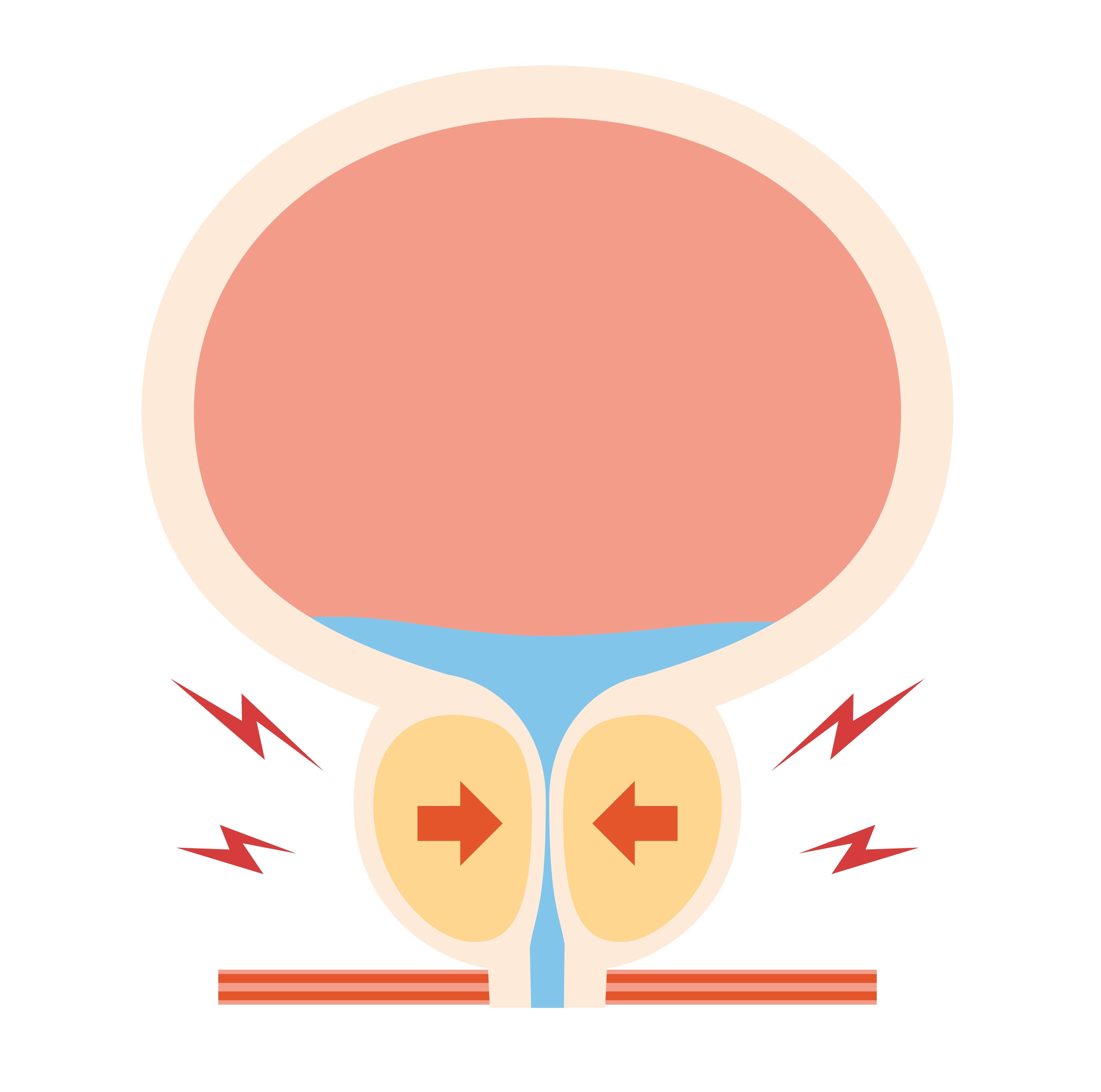 Prosta_Prostata_vergroessert